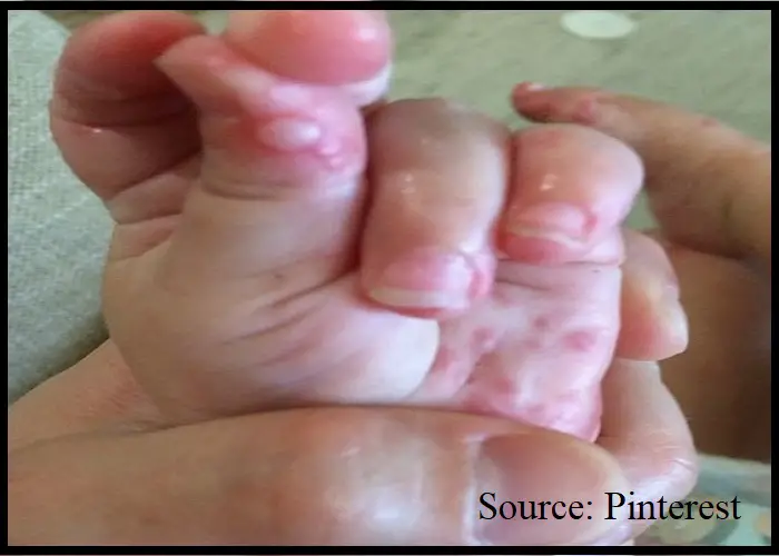 Hand, Foot, and Mouth Diseases in Children: Symptoms, Causes, Diagnosis, and Treatment
