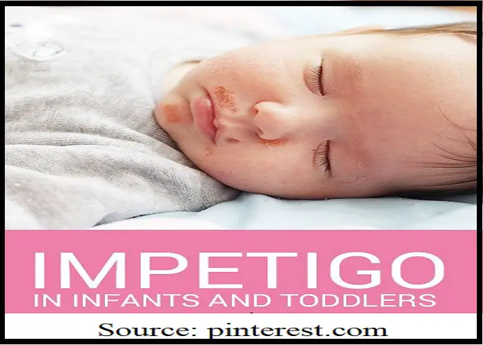 Impetigo: Contagious Skin Infection in Children – Symptoms, Prevention, Causes, and Treatment