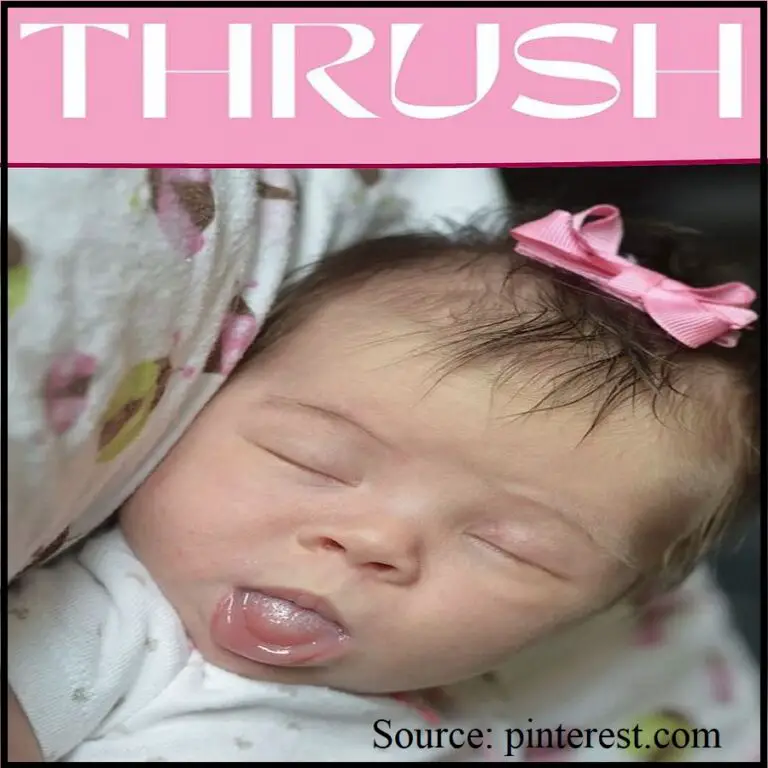 Thrush: Exploring Oral Yeast Infections in Babies and Toddlers